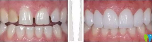 李向飛口腔瓷貼面修復效果