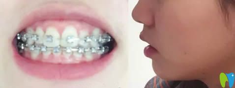 去泰安光彩口腔帶牙套10個(gè)月效果圖