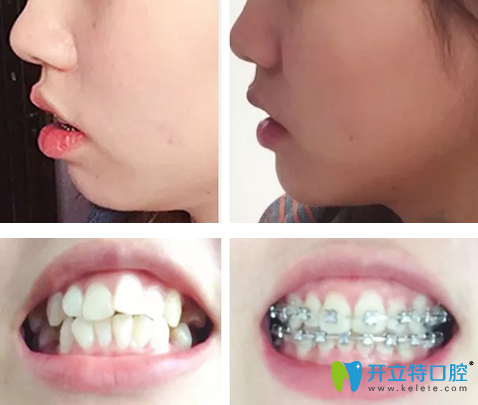 齙牙怎么矯正？曬泰安光彩口腔鋼絲矯正齙牙1-10個月變化圖