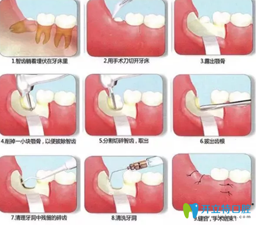 阻生智齒拔出過(guò)程圖 阻生智齒拔出過(guò)程圖