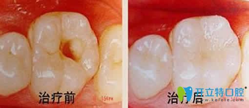 泉州維樂口腔謝碧享根管治療效果圖 泉州維樂口腔謝碧享根管治療效果圖