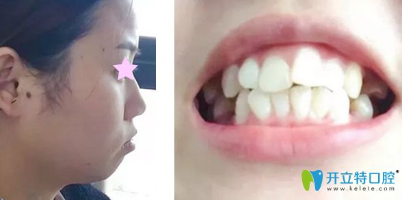 石家莊李向飛口腔矯正牙齒前 石家莊李向飛口腔矯正牙齒前