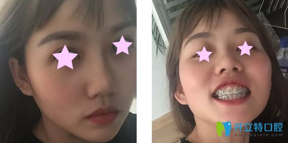 金屬托槽矯正牙齒10個月效果 金屬托槽矯正牙齒10個月效果