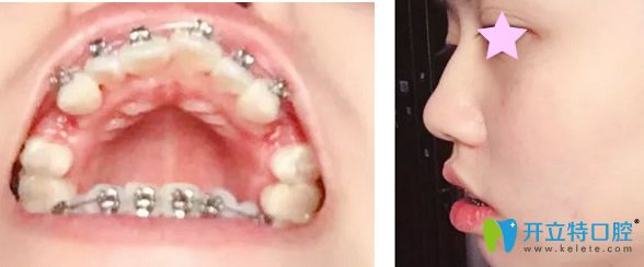 戴牙套天 戴牙套天