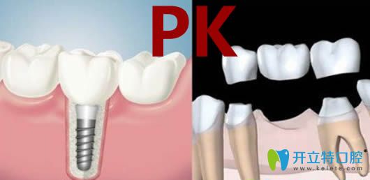 關(guān)于種牙好還是鑲牙好？請(qǐng)看價(jià)格/壽命/優(yōu)勢(shì)三方面大比拼