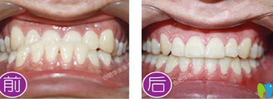 合肥華美口腔靠譜嗎？看華美牙齒矯正案例效果對(duì)比圖