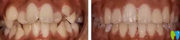 李永平院長隱形牙齒矯正代表案例