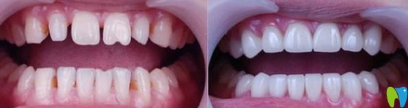 北京瑞泰口腔全瓷牙修復(fù)牙齒效果