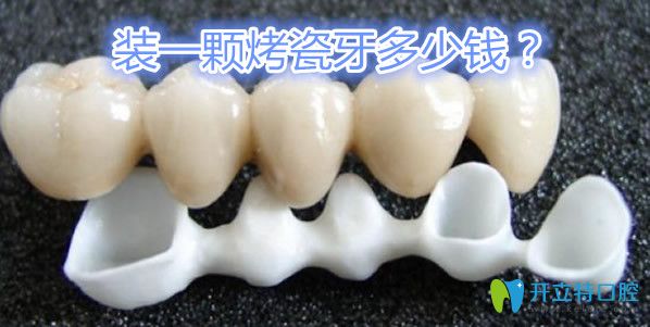 烤瓷牙的價(jià)格在600元—5000元左右