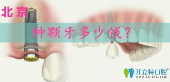 北京做種植牙多少錢?請看韓國奧齒泰和瑞士iti種植體價格表