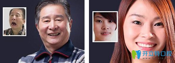 全口牙缺失種植及隱適美矯正牙齒前后效果對比圖