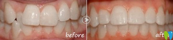 穗華口腔歪牙矯正效果案例