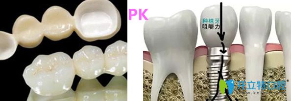 烤瓷牙和種植牙哪個好