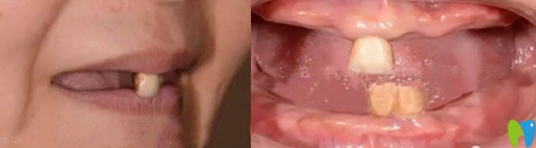 寧波美萊口腔牙齒缺失種植牙前