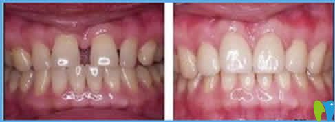 牙齒縫隙大矯正前后效果對比圖