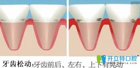 牙齒松動怎么治療?提供多條有效的治療及預(yù)防方法