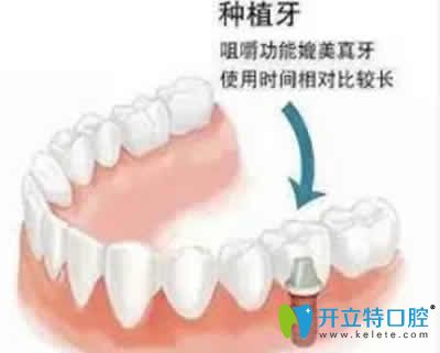 新疆凱樂(lè)口腔解惑 為什么單顆種植牙價(jià)格趕上奢侈品LV價(jià)格