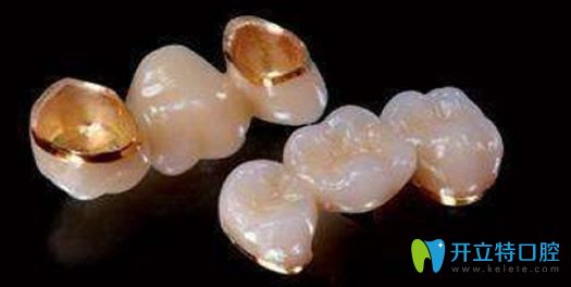 純鈦內冠烤瓷牙