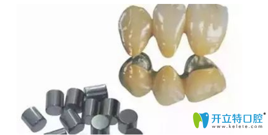 鈷鉻內冠烤瓷牙