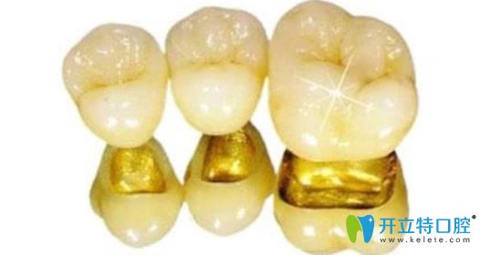 鍍金內冠烤瓷牙