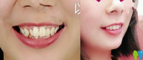 段斌金屬自鎖托槽矯正案例