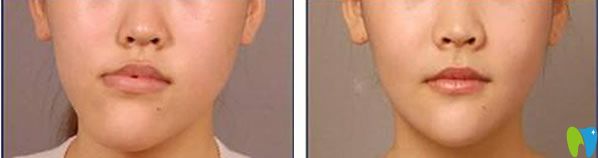 登特口腔牙齒矯正輕微改變臉型