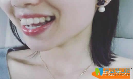 長(zhǎng)沙雅美口腔劉景醫(yī)生剛開(kāi)始給我做隱形牙齒矯正照片