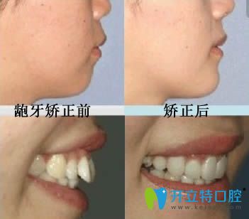 開立特口腔網站齙牙矯正前后對比圖