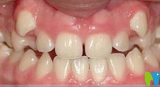 青島維樂口腔隱形矯正牙齒前 青島維樂口腔隱形矯正牙齒前