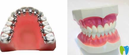 王曉琳院長科普隱適美和舌側(cè)矯正哪個(gè)好