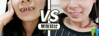 牙博士口腔怎么樣？看牙齒全瓷冠修復(fù)案例前后對比圖
