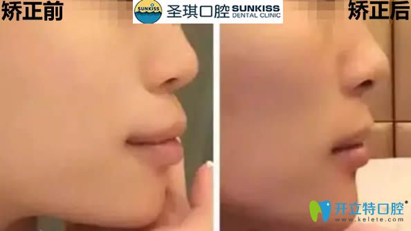 拔四顆牙的臉型變化圖