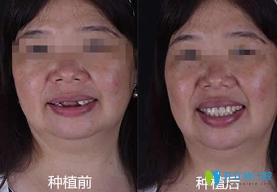 無錫通善口腔王杏松多顆牙種植案例效果圖 無錫通善口腔王杏松多顆牙種植案例效果圖