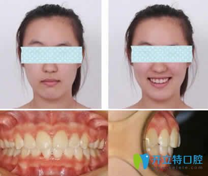 我在無(wú)錫通善口腔做隱形齙牙矯正一年后效果 我在無(wú)錫通善口腔做隱形齙牙矯正一年后效果