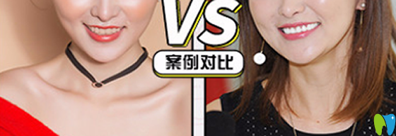 在沈陽歡樂仁愛口腔做牙齒瓷貼面治療前后對(duì)比案例 在沈陽歡樂仁愛口腔做牙齒瓷貼面治療前后對(duì)比案例