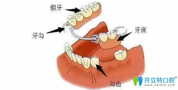 全口種植牙的價(jià)格和假牙為什么相差這么大