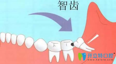 提供拔智齒前后注意事項以及四顆智齒全拔了會瘦臉的真相
