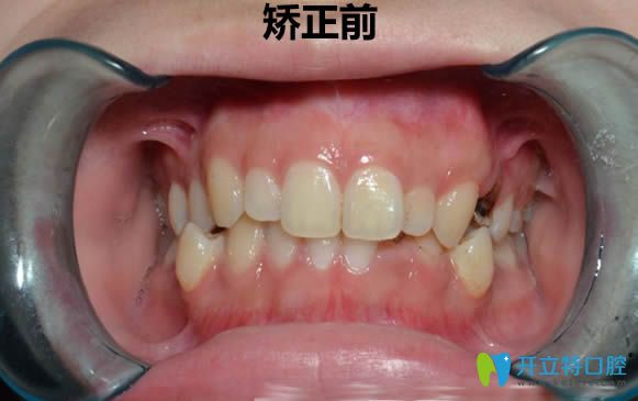 現(xiàn)分享我在廈門(mén)拜博沒(méi)有拔牙正畸的親身經(jīng)歷及前后對(duì)比照