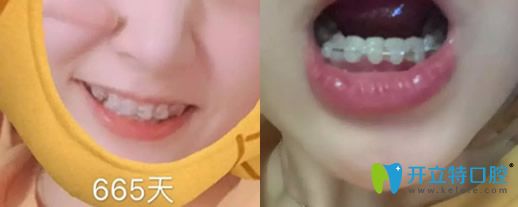 去沈陽歡樂口腔做牙齒半隱形矯正665天變化圖