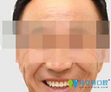 無錫通善口腔王杏松即刻種植牙案例效果圖 無錫通善口腔王杏松即刻種植牙案例效果圖