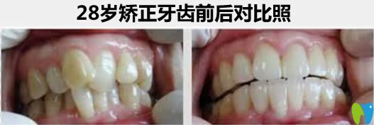 杭州瑞爾口腔謝迎醫(yī)生給28歲顧客矯正牙齒前后對比照