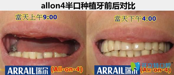 杭州瑞爾口腔allon4種植牙真實(shí)案例 杭州瑞爾口腔allon4種植牙真實(shí)案例