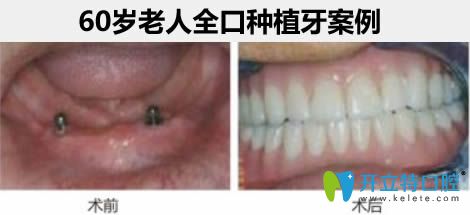 杭州瑞爾齒科<!--<i data=20240703-sp></i>-->鑫醫(yī)生60歲老人全口種植牙案例