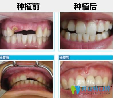 杭州瑞爾齒科<!--<i data=20240703-sp></i>-->鑫醫(yī)生半口種植牙前后對比案例