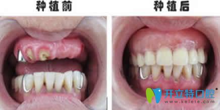 寧波尚善口腔賀剛種植牙案例效果圖