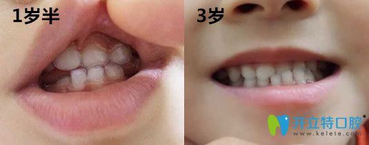 3歲孩子在哈爾濱大象口腔做牙齒地包天矯正前圖片 3歲孩子在哈爾濱大象口腔做牙齒地包天矯正前圖片