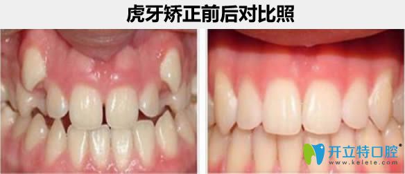 杭州瑞爾齒科成人虎牙矯正案例及前后對比照 杭州瑞爾齒科成人虎牙矯正案例及前后對比照