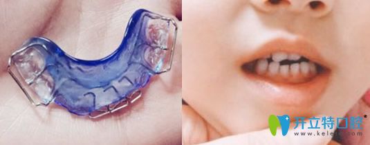 在哈爾濱大象口腔做牙齒矯正初戴矯正器 在哈爾濱大象口腔做牙齒矯正初戴矯正器