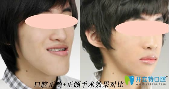開立特口腔正畸和正頜手術(shù)效果對比圖