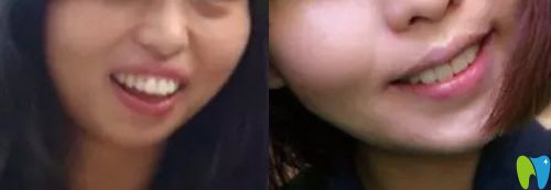 重慶牙科哪家好，看美維口腔齙牙矯正案例效果圖